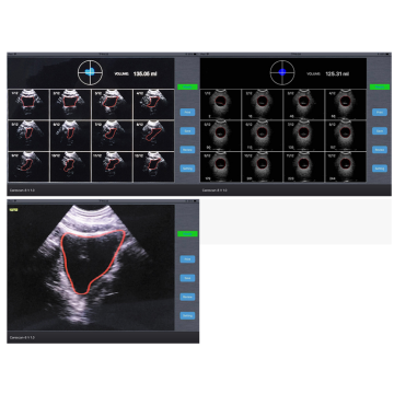 ultrasound bladder volume scanner
